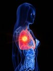 Рак легких у женщин прозрачный, концептуальная компьютерная иллюстрация . — стоковое фото