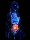 Dünndarm- und Darmkrebs im weiblichen Körper, konzeptionelle Computerillustration. — Stockfoto
