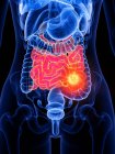 Cancer de l'intestin grêle et de l'intestin chez la femme, illustration conceptuelle par ordinateur
. — Photo de stock