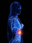 Cancro allo stomaco nel corpo femminile, illustrazione concettuale del computer . — Foto stock