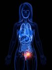 Рак яєчників у жіночому тілі, концептуальна комп'ютерна ілюстрація . — стокове фото
