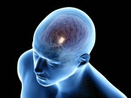Menschlicher Körper mit detailliertem Hypothalamus im Gehirn, Computerillustration. — Stockfoto