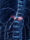Glandulas supra-renais doentes no corpo humano, ilustração digital conceitual . — Fotografia de Stock