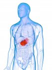 Erkrankter Magen in männlicher Körpersilhouette, konzeptionelle Computerillustration. — Stockfoto