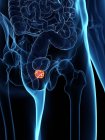 Entzündete Prostata im abstrakten männlichen Körper, digitale Illustration. — Stockfoto