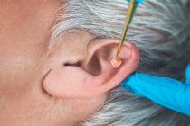 Aurikulotherapie oder Aurikularbehandlung am menschlichen Ohr mit flexiblem Messing-Ohrstift aus nächster Nähe. Akupunkturdruck auf Ohrenkörner. — Stockfoto