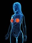 Жіночий анатомічний силует при захворюваннях молочної залози, концептуальна комп'ютерна ілюстрація . — стокове фото