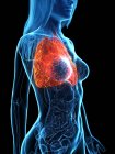 Kranke Lungen im transparenten Frauenkörper auf schwarzem Hintergrund, Computerillustration. — Stockfoto