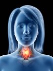 Cancer de la thyroïde dans le corps féminin, illustration conceptuelle par ordinateur . — Photo de stock