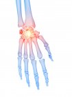 Human skeleton with hand pain, conceptual computer illustration. — Stock Photo