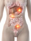 Weiblicher Körper mit Krebs-Metastasen, konzeptionelle Computerillustration. — Stockfoto