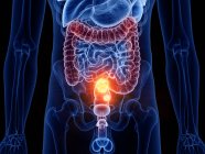 Абстрактное мужское тело с раком толстой кишки, компьютерная иллюстрация . — стоковое фото