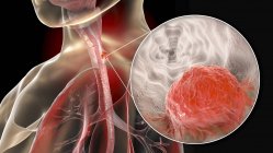 Speiseröhrenkrebs, zusammengesetzte digitale Illustration mit menschlichem Körper und Krebszelle. — Stockfoto