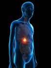 Ilustração digital da anatomia do homem sênior mostrando tumor da vesícula biliar . — Fotografia de Stock