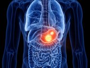 Абстрактное прозрачное мужское тело с пылающим раком желудка, цифровая иллюстрация . — стоковое фото