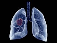Пухлина легень, комп'ютерна ілюстрація — стокове фото