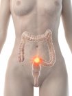 Cuerpo femenino con cáncer de colon, ilustración conceptual por computadora . - foto de stock