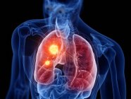 Silhueta masculina abstrata com câncer de pulmão, ilustração digital . — Fotografia de Stock