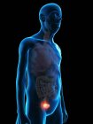 Ilustración digital de la anatomía del hombre mayor que muestra un tumor urinario de vejiga . - foto de stock