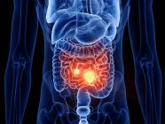 Cuerpo masculino abstracto con cáncer de intestino delgado, ilustración por computadora . - foto de stock