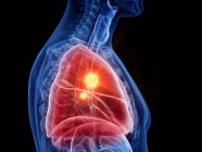 Silhueta masculina abstrata com câncer de pulmão, ilustração digital . — Fotografia de Stock