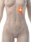 Cuerpo femenino con cáncer de bazo, ilustración conceptual por computadora . - foto de stock
