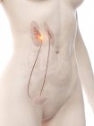 Anatomischer weiblicher Körper mit Harnleiterkrebs, konzeptionelle digitale Illustration. — Stockfoto