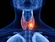 Абстрактное прозрачное мужское тело с пылающим раком щитовидной железы, цифровая иллюстрация . — стоковое фото