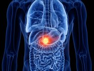 Bauchspeicheldrüsenkrebs im männlichen Körper, Computerillustration. — Stockfoto