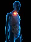 Digital illustration of senior man anatomy showing thyroid gland tumour. — Stock Photo