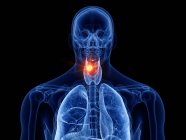 Cuerpo masculino transparente abstracto con cáncer de laringe brillante, ilustración digital . - foto de stock