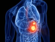 Абстрактное прозрачное мужское тело с пылающим раком желудка, цифровая иллюстрация . — стоковое фото