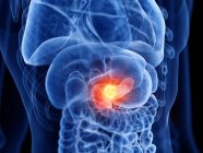 Bauchspeicheldrüsenkrebs im männlichen Körper, Computerillustration. — Stockfoto