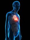 Ilustração digital da anatomia do homem sênior mostrando tumor cardíaco . — Fotografia de Stock