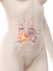 Cuerpo femenino con cáncer de intestino delgado, ilustración conceptual por computadora . - foto de stock