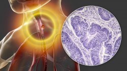Оофагеальний рак, комп'ютерна ілюстрація та легкий мікрограф ракових тканин . — стокове фото