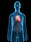 Illustration numérique de l'anatomie d'un homme âgé montrant une tumeur cardiaque . — Photo de stock