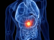 Pancreas cancer in male body, computer illustration. — Stock Photo
