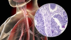 Câncer esofágico, ilustração computacional e micrografia de luz do tecido cancerígeno . — Fotografia de Stock