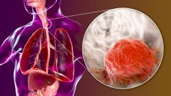 Oesophageal cancer, composite digital illustration with human body and cancer cell. — Stock Photo
