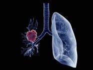 Tumor pulmonar, ilustración por ordenador - foto de stock