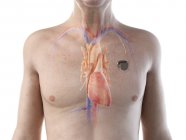 Медична цифрова ілюстрація старшого чоловіка з кардіостимулятором в серці . — стокове фото