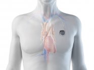 Ilustración digital médica del hombre mayor con marcapasos cardíaco en el corazón . - foto de stock