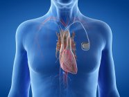 Ilustración digital médica del hombre mayor con marcapasos cardíaco en el corazón . - foto de stock