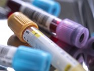 Primo piano del sangue umano e di vari campioni di hiv nelle provette durante lo screening in laboratorio medico . — Foto stock