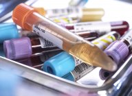 Close-up de urina humana, sangue e várias amostras médicas em tubos de ensaio durante a triagem em laboratório médico . — Fotografia de Stock