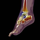 Osso do tornozelo fracturado, ilustração do computador — Fotografia de Stock