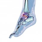 Osso do tornozelo fracturado, ilustração do computador — Fotografia de Stock