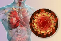 Coronavirus causa polmonite, illustrazione concettuale del computer — Foto stock