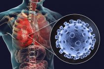 Коронавіруси викликають пневмонію, концептуальну комп'ютерну ілюстрацію — стокове фото